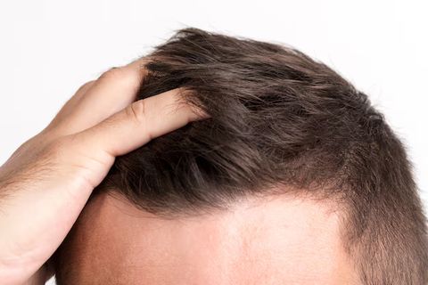 Hair Transplants: A Clear and Comprehensive Guide